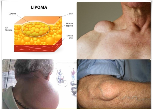 Obat Penghilang Lipoma